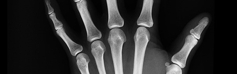 X-ray X-ray